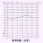 中度耳聋听力图